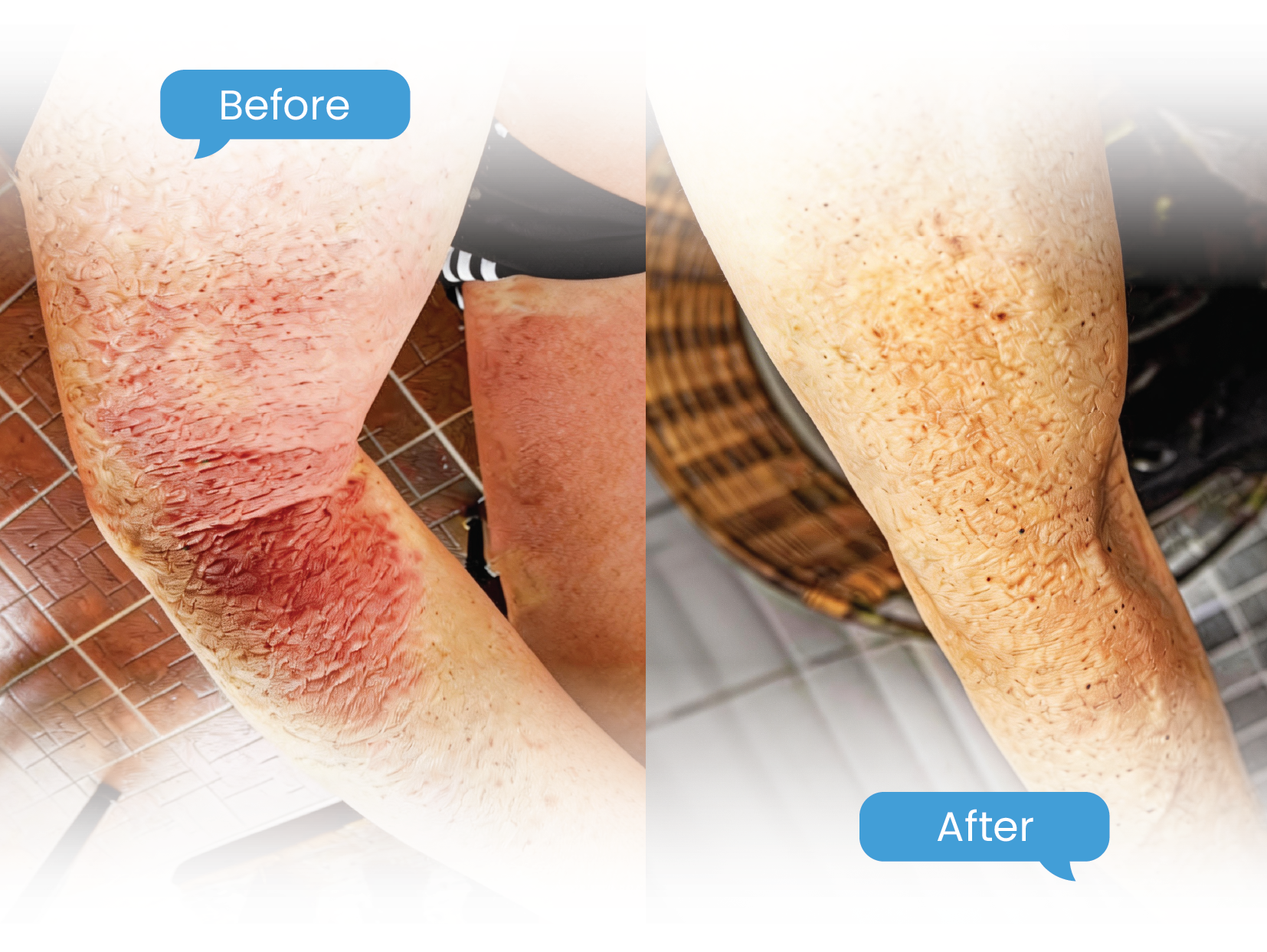 before & after shoulder-01